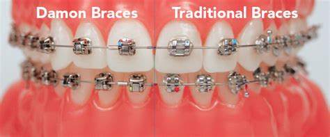 metal content of damen brackets|damon bracket theory.